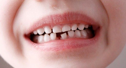Çocuklarda Çarpık Diş Tedavisi