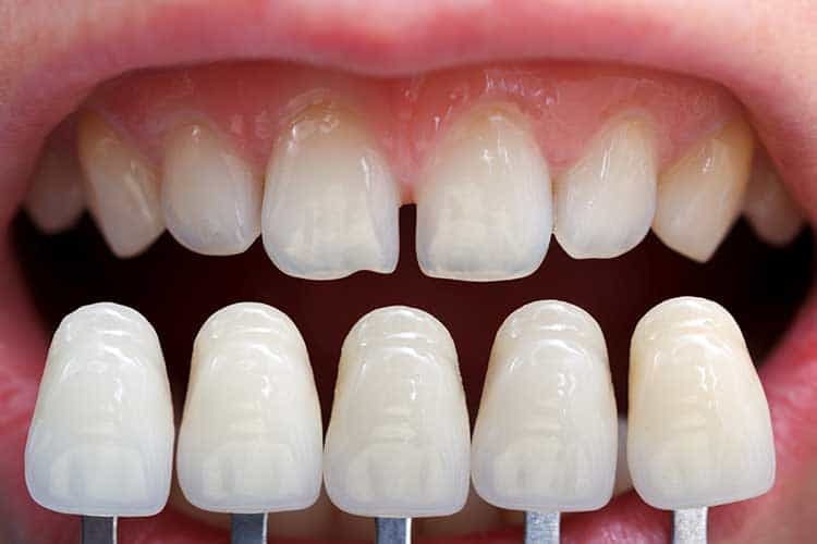Lamine diş (porselen kaplama) nedir?