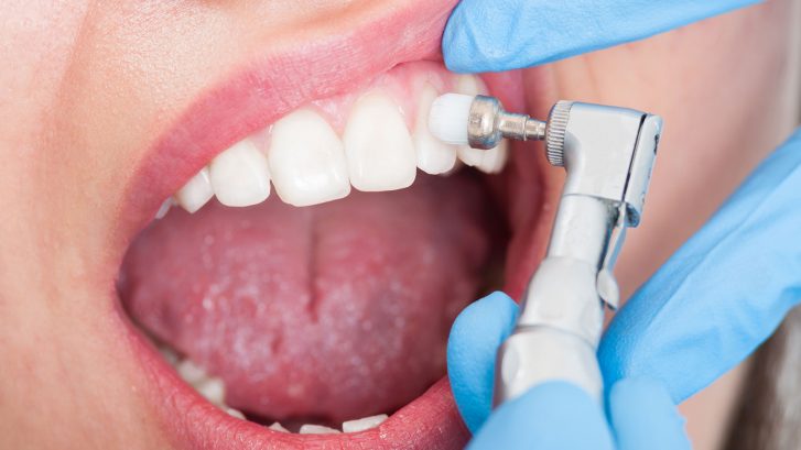 Diş taşı – Tartar nedir? Temizlenmesi neden önemlidir?