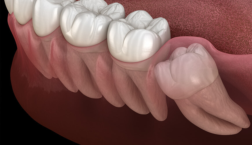 Gömülü 20’lik Dişlerin Ağız ve Diş Sağlığına Zararları Nelerdir?