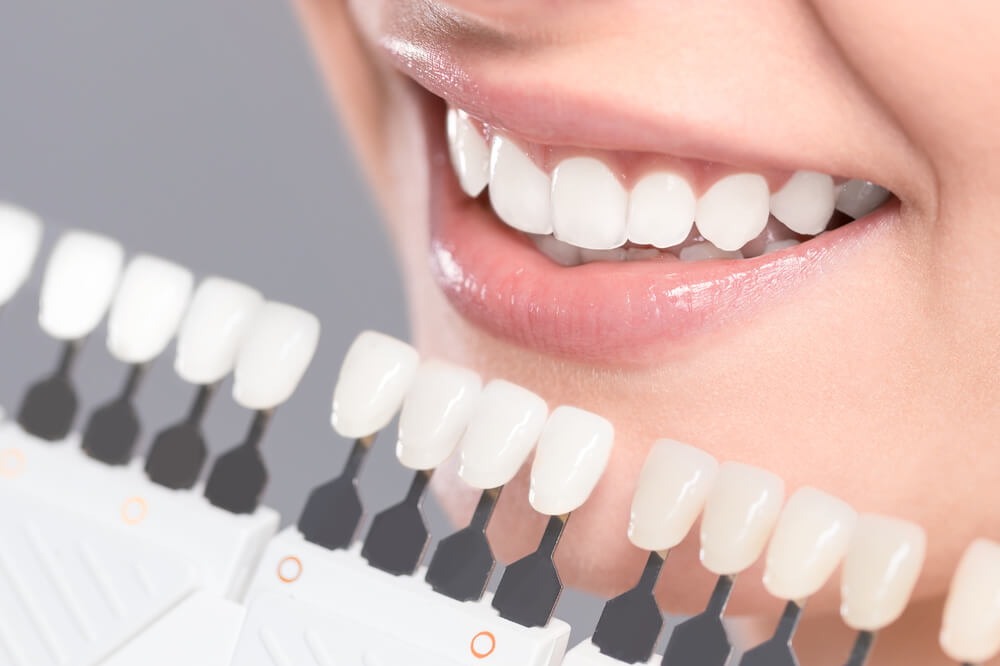 Porselen Diş Laminaları Hangi Durumlarda Uygulanır?