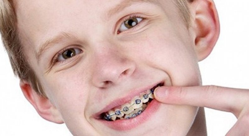 Çocuklarda Ortodonti Tedavisi